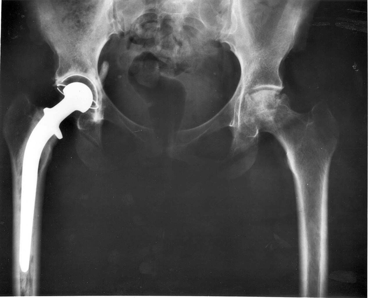 Picture of Hip Replacement Surgery